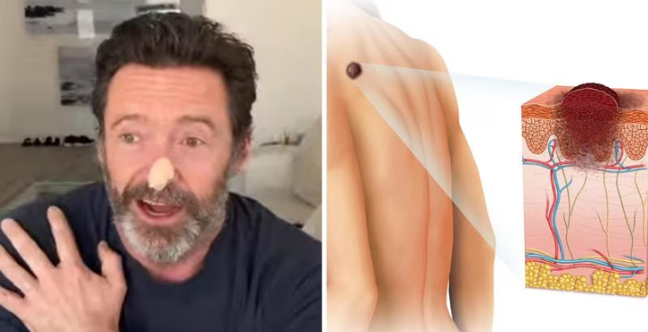 Carcinoma, la enfermedad que padece Hugh Jackman; el actor se sometió a dos biopsias