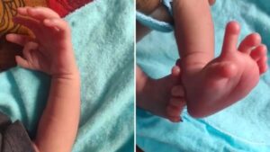 Nace bebe con 26 dedos en manos y pies