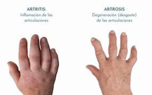 Artritis vs Artrosis: Desentrañando las diferencias para una vida con buena salud
