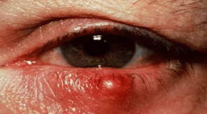 ¿Qué es un tutupiche, lo que tiene AMLO en su ojo izquierdo?