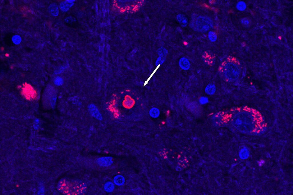 ¡Por fin! Luego de 25 años descubren origen genético de enfermedad neurológica rara