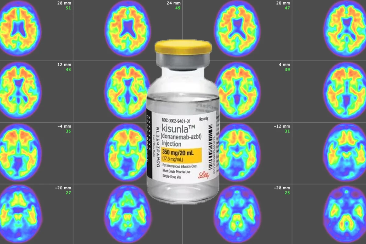 La FDA aprueba Donanemab tratamiento del Alzheimer en fase inicial