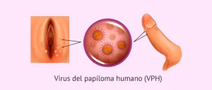 verrugas virus del papiloma humano