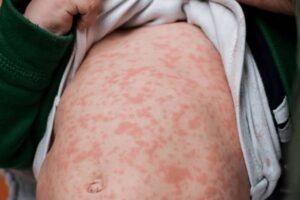 Detectan primer caso de sarampión en Quintana Roo, registrado en una menor en Bacalar