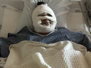 Mujer se desfiguró la cara al asar malvaviscos en una fogata