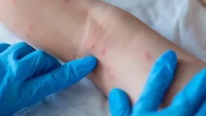 Paciente con posible viruela del mono ingresa al Hospital General de Cancún