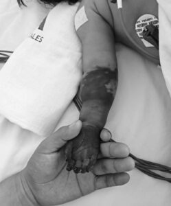 Bebé podría perder su manita por presunta negligencia en HG de Cancún: denuncia familia