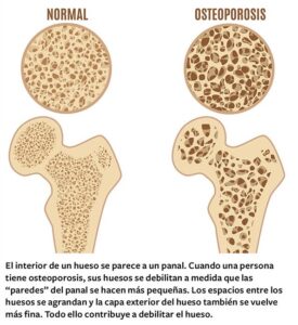 Qué alimentos evitan la Osteoporosis después de los 45