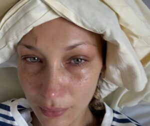 Bella Hadid lucha contra la enfermedad de Lyme 