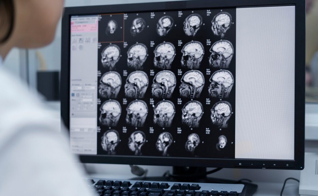 EPILEPSIA 1
