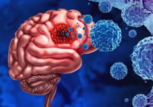 Este es el  cáncer cerebral que erosiona los huesos del cráneo
