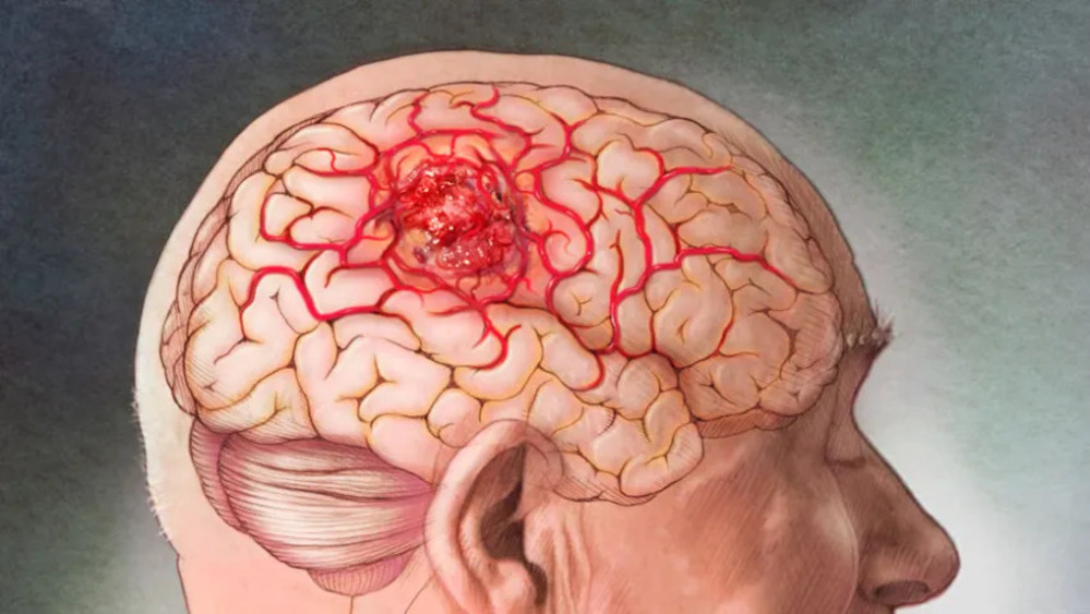 cancer de cerebro 1