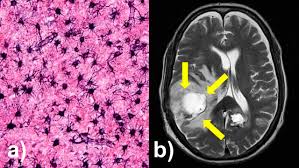 Este es el  cáncer cerebral que erosiona los huesos del cráneo